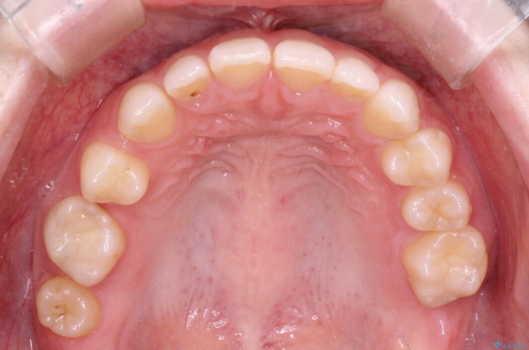 気になる隙間を矯正治療とインプラント治療で改善 治療前