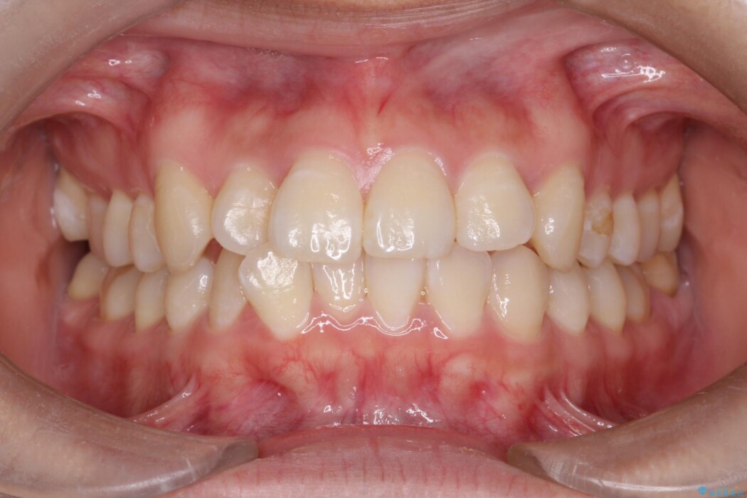 前歯の凸凹をマウスピース矯正で治す 治療前