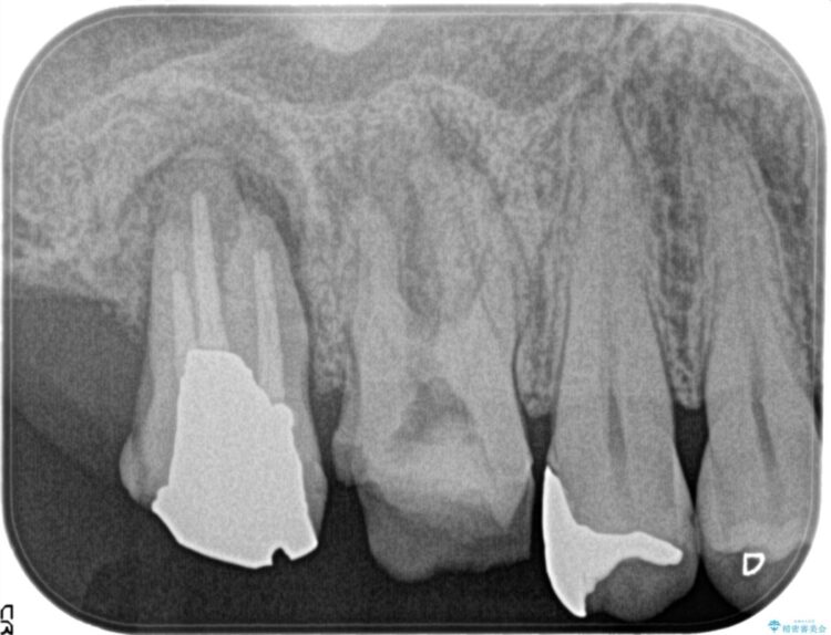 湾曲した根管の精密根管治療 治療前画像
