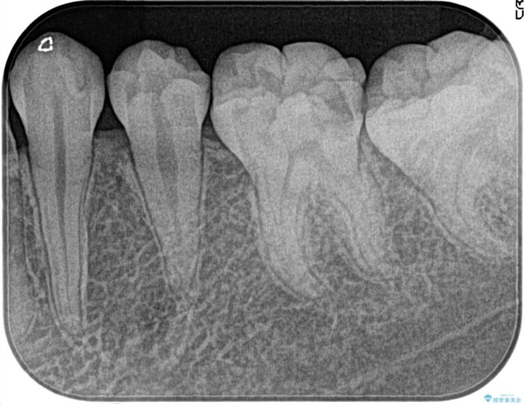 【20代女性】昨晩から奥歯が激痛 精密根管治療（イニシャルケース） 治療前画像