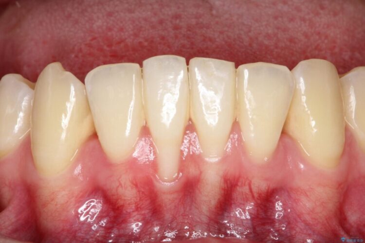 下顎前歯の歯ぐき退縮を歯肉移植による根面被覆で改善 治療前画像
