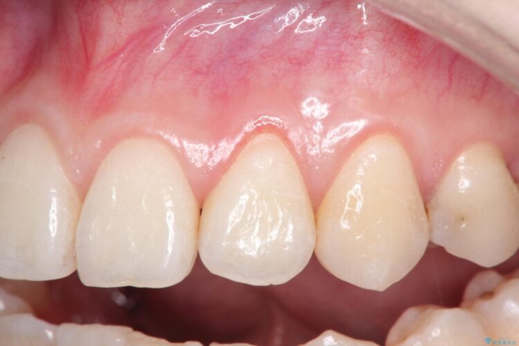 前歯の歯肉退縮を歯肉弁歯冠側移動術で改善 治療前画像