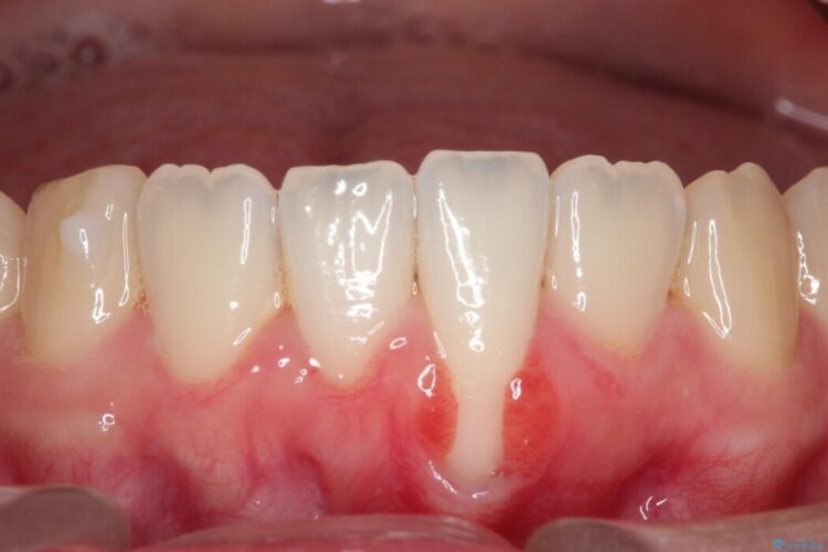結合組織移植術で下がった歯肉を再生 治療前画像