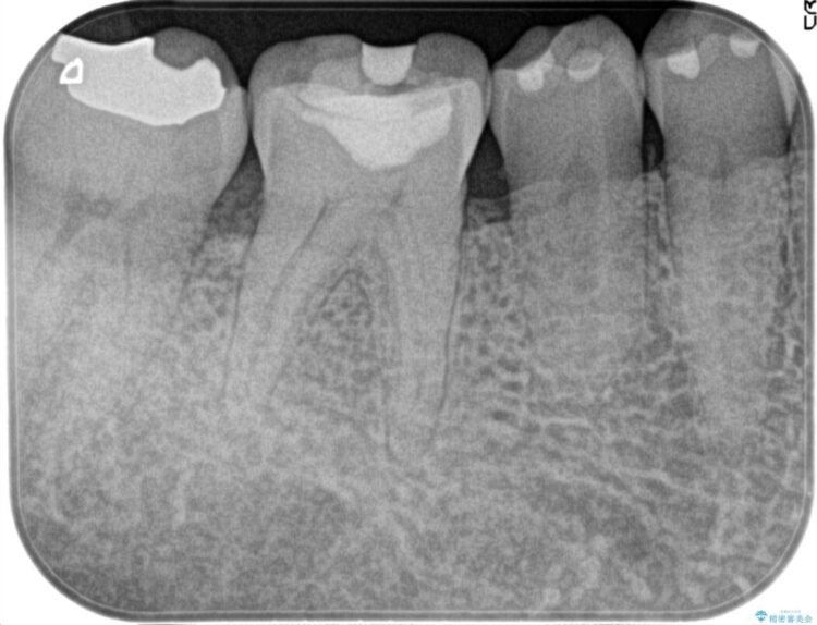 冷たいもので奥歯が痛む。精密根管治療とオールセラミッククラウン ビフォー