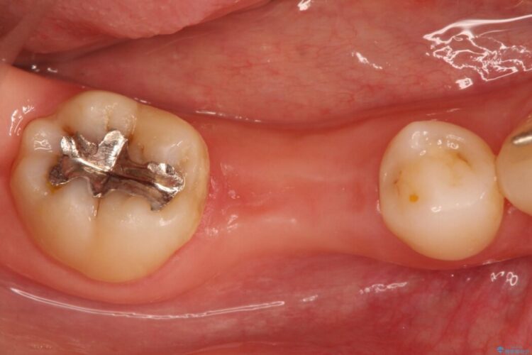 インプラント治療でしっかり噛める奥歯に 治療前画像