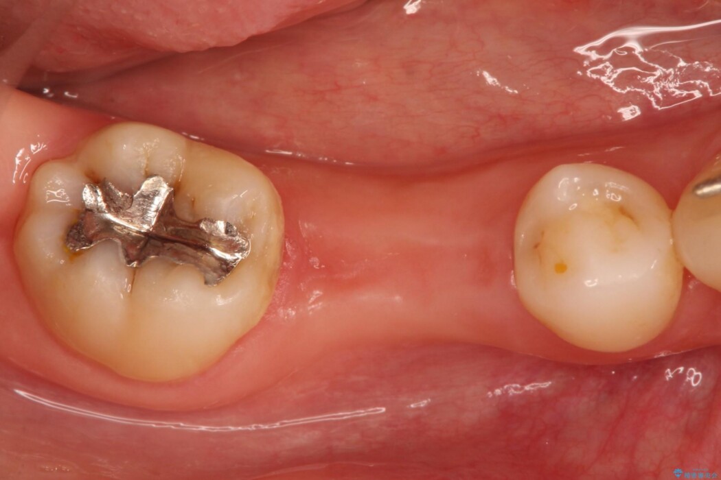 インプラント治療でしっかり噛める奥歯に 治療前