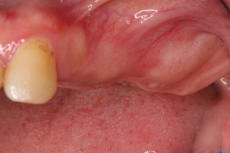 抜歯した奥歯部分に歯を入れたい 治療前画像