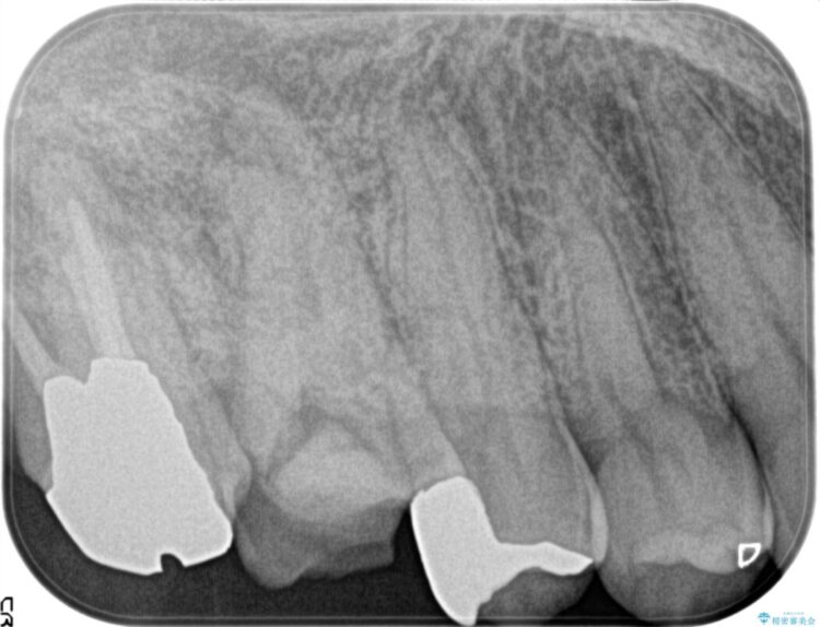 湾曲した根管の精密根管治療 治療前画像