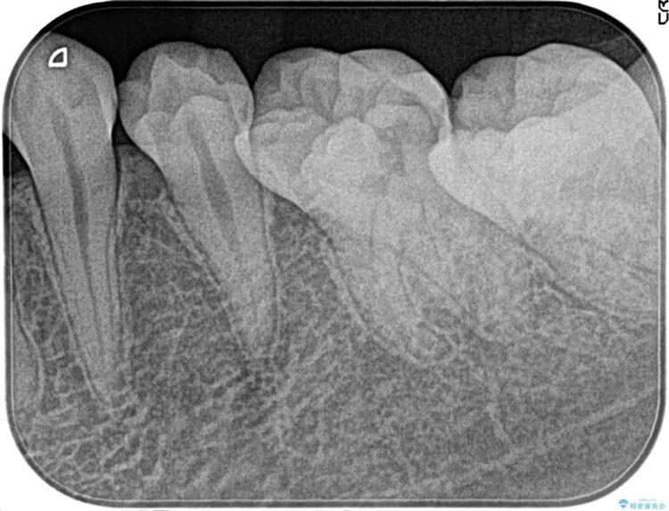 【20代女性】昨晩から奥歯が激痛 精密根管治療（イニシャルケース） 治療前画像