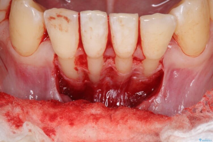 下顎前歯の歯ぐき退縮を歯肉移植による根面被覆で改善 治療前画像
