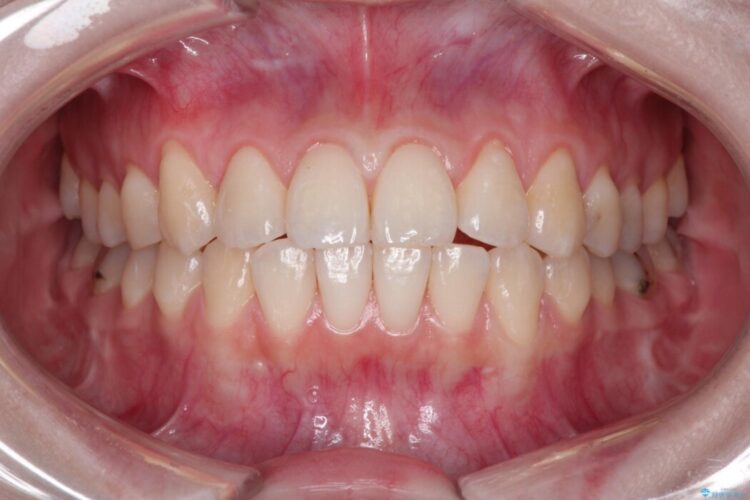 前歯の歯肉退縮を歯肉弁歯冠側移動術で改善 治療前画像