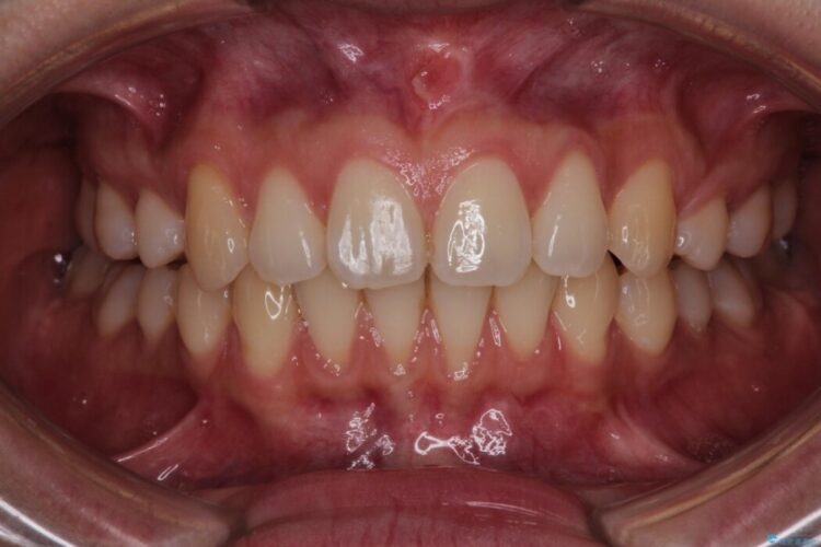 エムドゲインで骨を再生し、歯茎の移植で前歯の歯肉退縮をきれいに 治療前画像