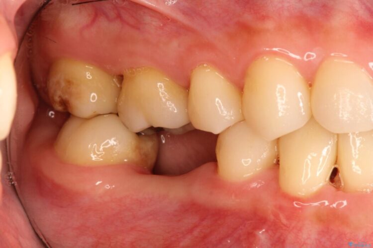 インプラント治療でしっかり噛める奥歯に 治療前画像