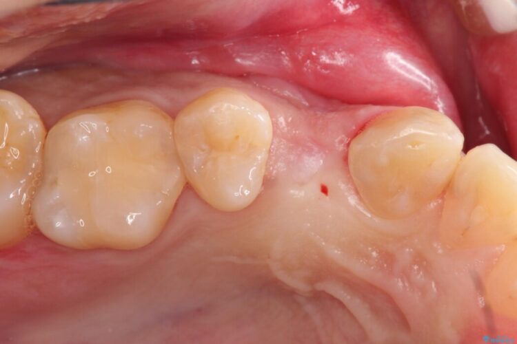 上顎4番のインプラント治療 治療前画像