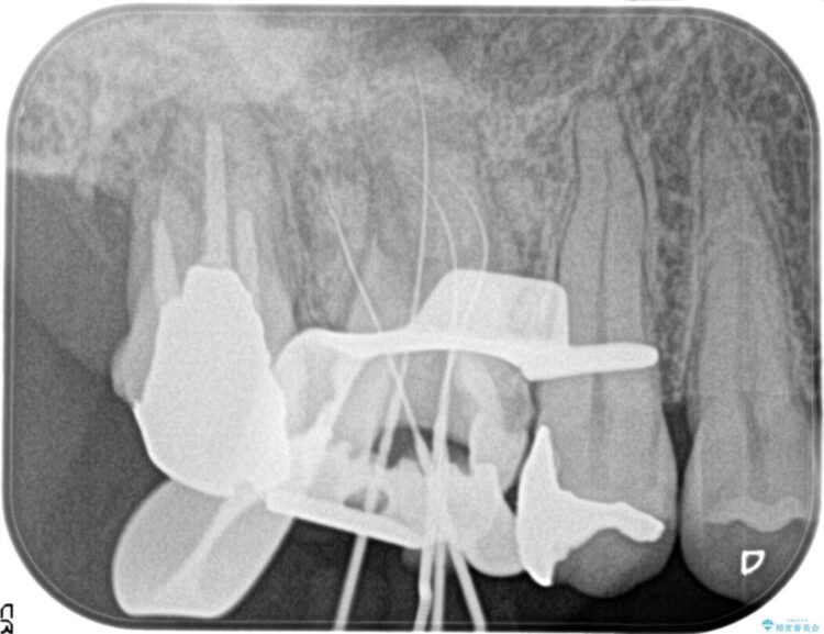 湾曲した根管の精密根管治療 治療前画像