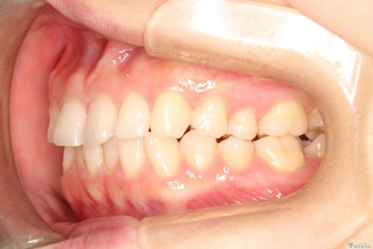 インビザラインで前歯のガタガタ（叢生）を綺麗に 治療前画像