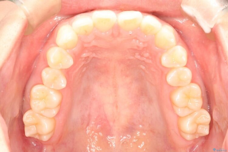 インビザラインで前歯のガタガタ（叢生）を綺麗に 治療前画像