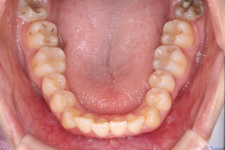 ハーフリンガルで目立たず、口ゴボの改善 治療前画像