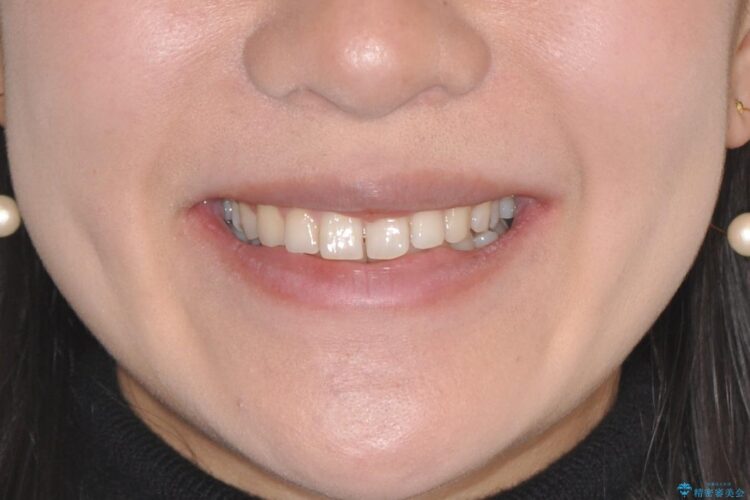 インビザラインで前歯のガタガタ（叢生）を綺麗に 治療前画像