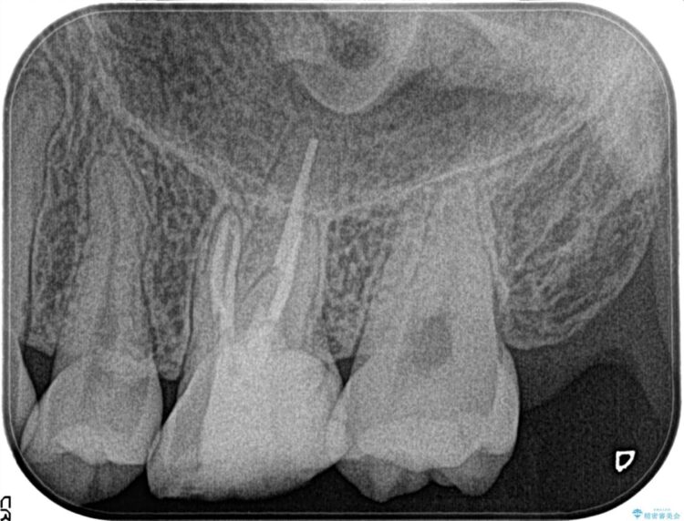 ズキズキ痛む奥歯を精密根管治療で解決 治療後画像