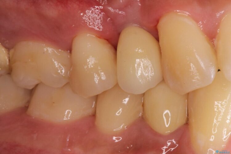 上顎4番のインプラント治療 アフター