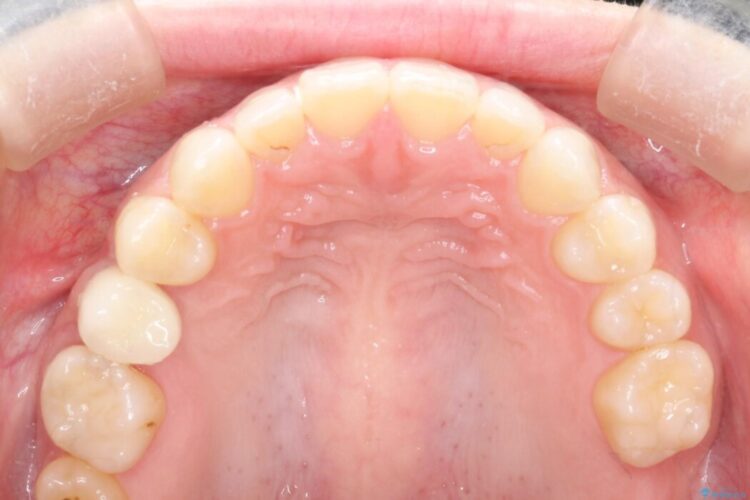 気になる隙間を矯正治療とインプラント治療で改善 治療後画像