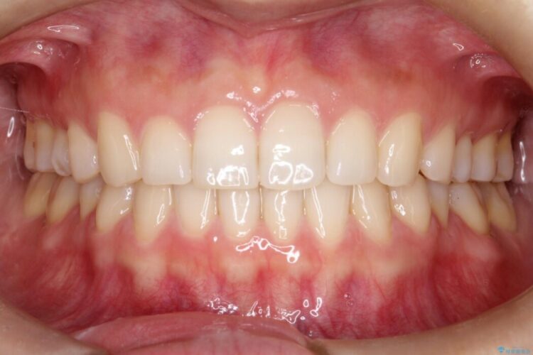 インビザラインで前歯のガタガタ（叢生）を綺麗に 治療後画像