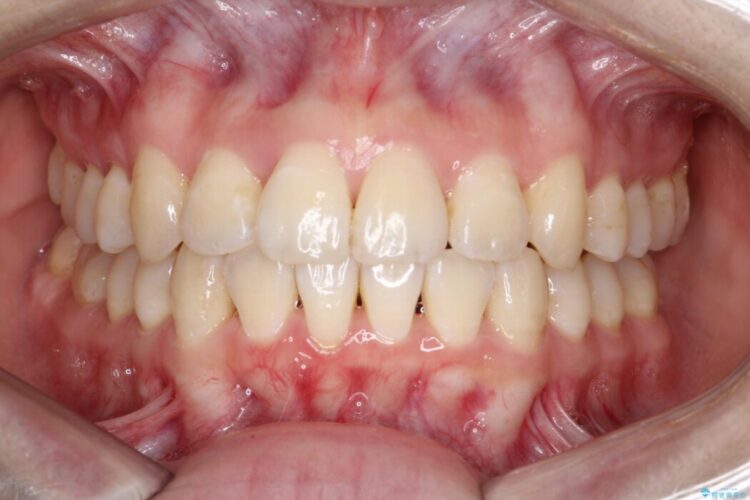 前歯の凸凹をマウスピース矯正で治す アフター