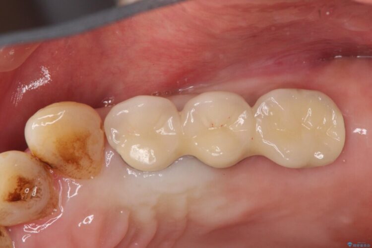 抜歯した奥歯部分に歯を入れたい 治療後画像