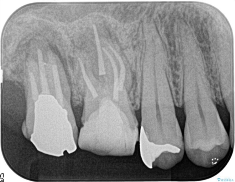 湾曲した根管の精密根管治療 アフター
