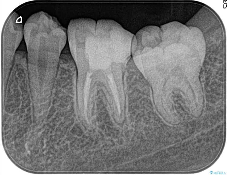 【20代女性】昨晩から奥歯が激痛 精密根管治療（イニシャルケース） アフター