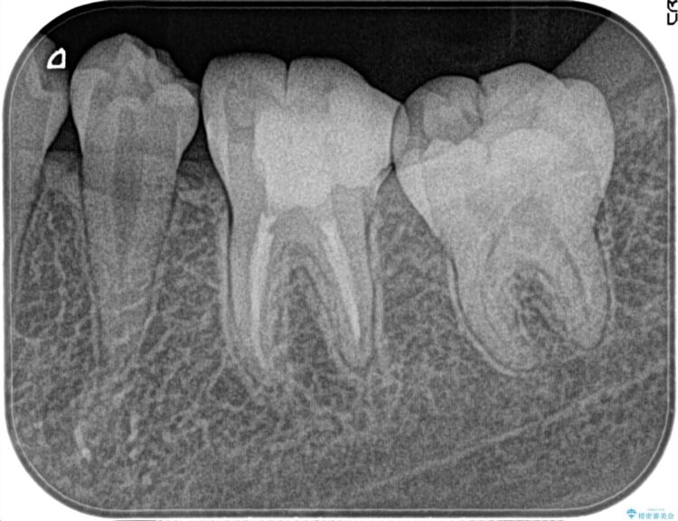 【20代女性】昨晩から奥歯が激痛 精密根管治療（イニシャルケース） 治療後画像