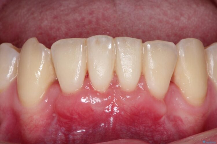 下顎前歯の歯ぐき退縮を歯肉移植による根面被覆で改善 治療後画像