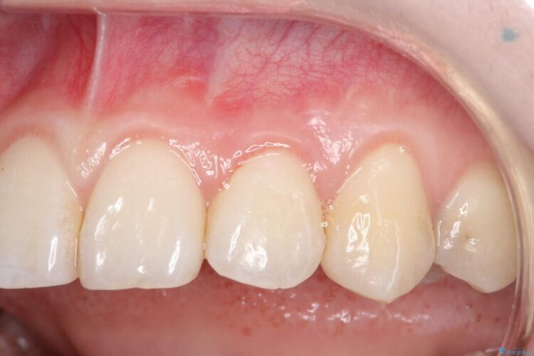 前歯の歯肉退縮を歯肉弁歯冠側移動術で改善 治療後画像
