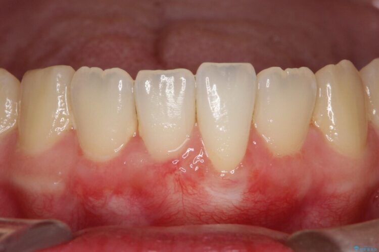 結合組織移植術で下がった歯肉を再生 治療後画像