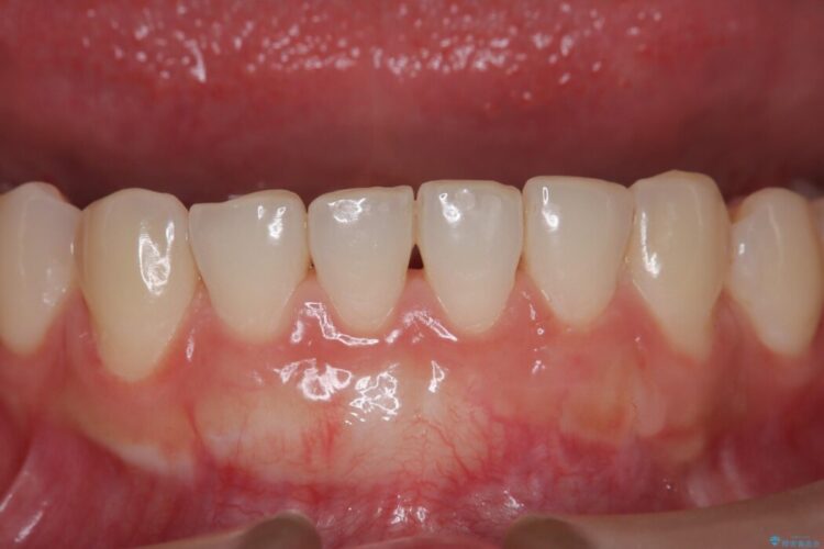 エムドゲインで骨を再生し、歯茎の移植で前歯の歯肉退縮をきれいに アフター