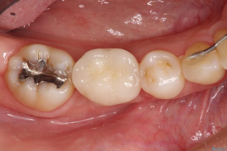 インプラント治療でしっかり噛める奥歯に 治療後画像