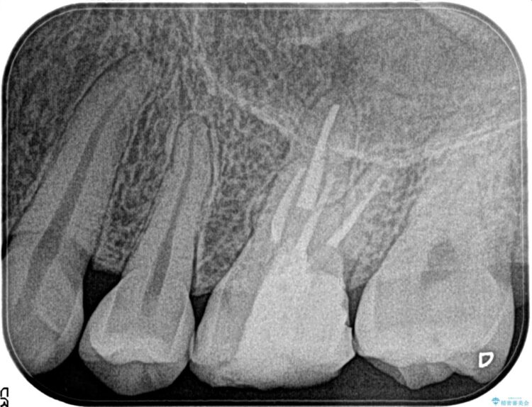 ズキズキ痛む奥歯を精密根管治療で解決 治療後画像