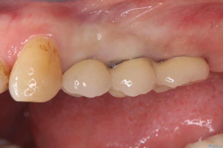 抜歯した奥歯部分に歯を入れたい 治療後画像