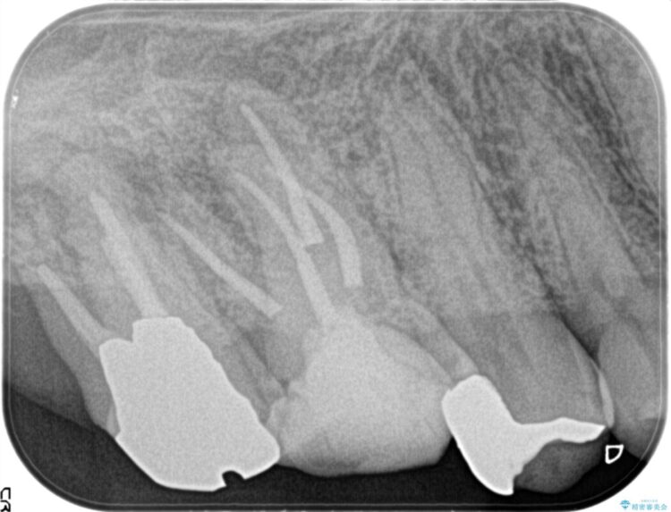 湾曲した根管の精密根管治療 治療後画像