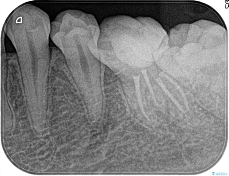 【20代女性】昨晩から奥歯が激痛 精密根管治療（イニシャルケース） 治療後画像