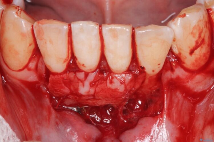 下顎前歯の歯ぐき退縮を歯肉移植による根面被覆で改善 治療後画像