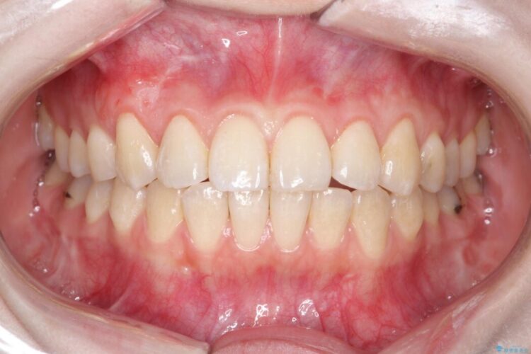前歯の歯肉退縮を歯肉弁歯冠側移動術で改善 治療後画像