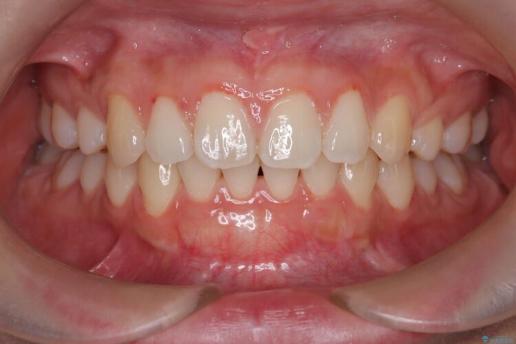 エムドゲインで骨を再生し、歯茎の移植で前歯の歯肉退縮をきれいに 治療後画像