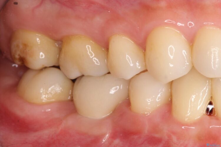 インプラント治療でしっかり噛める奥歯に 治療後画像