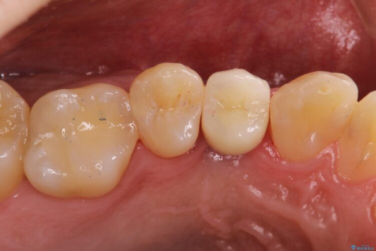 上顎4番のインプラント治療 治療後画像