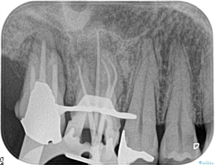湾曲した根管の精密根管治療 治療後画像