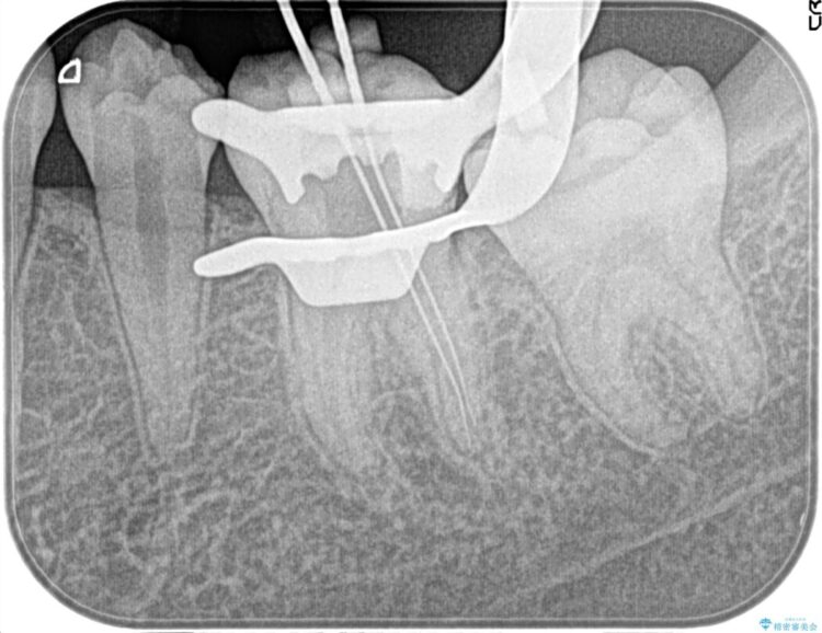 【20代女性】昨晩から奥歯が激痛 精密根管治療（イニシャルケース） 治療後画像