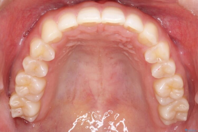 インビザラインで前歯のガタガタ（叢生）を綺麗に 治療後画像