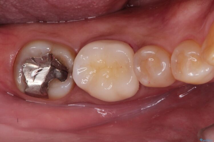 冷たいもので奥歯が痛む。精密根管治療とオールセラミッククラウン 治療後画像